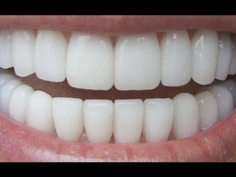 Ako si vybieliť zuby doma a bez drahých prípravkov